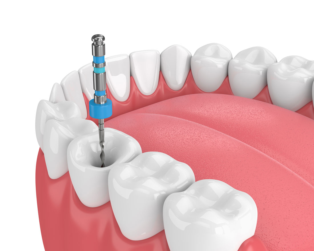 clínica dental en Tomares, dentista en Tomares, endodoncia en Tomares