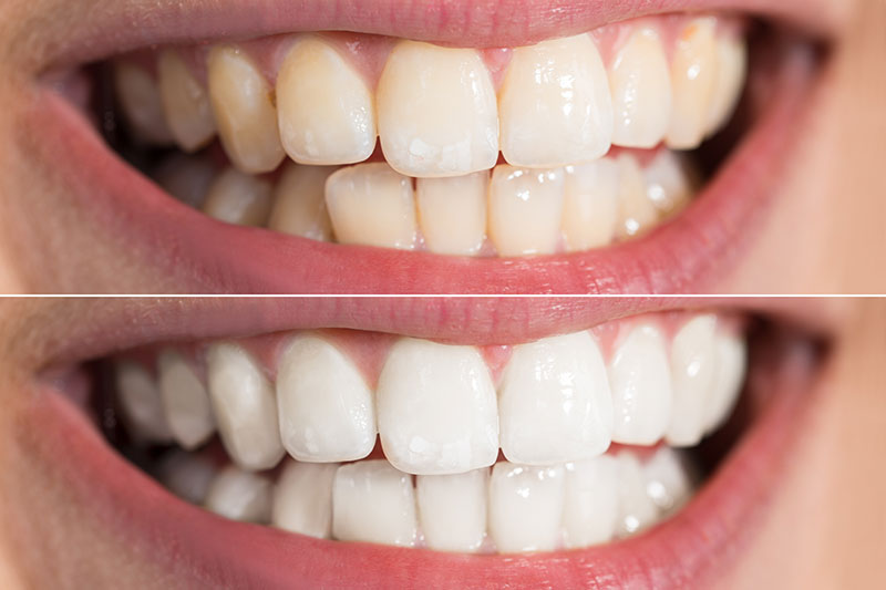 polident_sevilla-tratamientos-estetica-dental-blanqueamiento clínica dental en Tomares, dentista en Tomares, estética dental en Tomares, blanqueamiento dental en Tomares, carillas dentales en Tomares, diseño de sonrisa en Tomares.