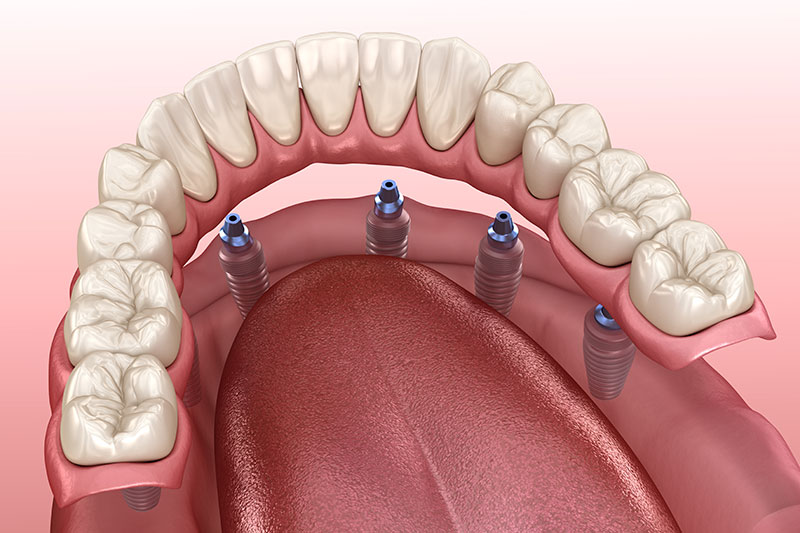 polident_sevilla-tratamientos-implantes-dentales-all-on clínica dental en Tomares, dentista en Tomares, implantes dentales en Tomares, implantes dentales en dos fases en Tomares, implantes dentales de carga inmediata en Tomares, implantes dentales all-on-four en Tomares, implantes dentales all-on-six en Tomares.