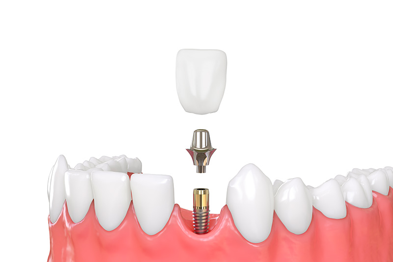 polident_sevilla-tratamientos-implantes-dentales-carga-inmediata clínica dental en Tomares, dentista en Tomares, implantes dentales en Tomares, implantes dentales en dos fases en Tomares, implantes dentales de carga inmediata en Tomares, implantes dentales all-on-four en Tomares, implantes dentales all-on-six en Tomares.