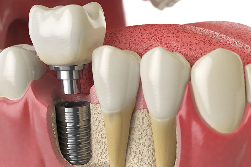 polident_sevilla-tratamientos-implantes-dentales-dos-fases clínica dental en Tomares, dentista en Tomares, implantes dentales en Tomares, implantes dentales en dos fases en Tomares, implantes dentales de carga inmediata en Tomares, implantes dentales all-on-four en Tomares, implantes dentales all-on-six en Tomares.
