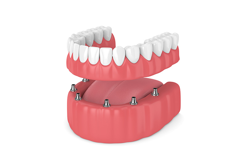 polident_sevilla-tratamientos-implantes-dentales-protesis clínica dental en Tomares, dentista en Tomares, implantes dentales en Tomares, implantes dentales en dos fases en Tomares, implantes dentales de carga inmediata en Tomares, implantes dentales all-on-four en Tomares, implantes dentales all-on-six en Tomares