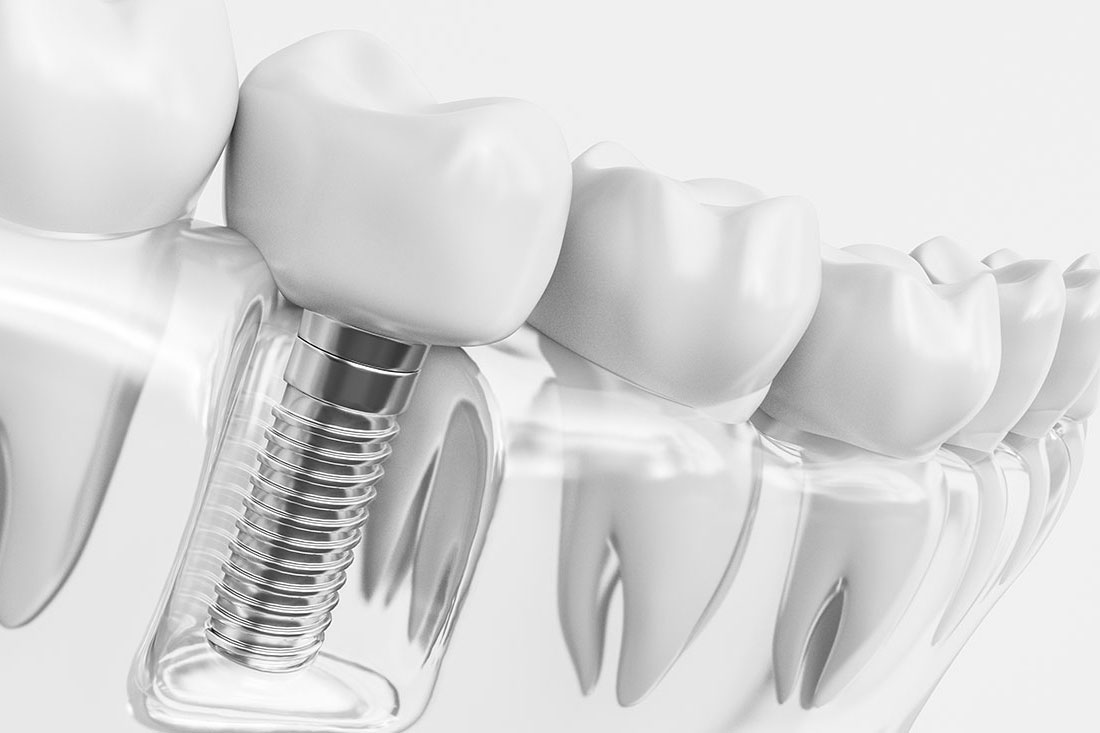 Implantes dentales