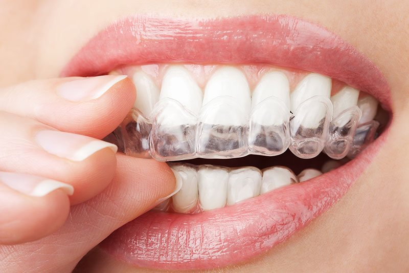 polident_sevilla-tratamientos-ortodoncia-invisible3 clínica dental en Tomares, dentista en Tomares, ortodoncia en Tomares, ortodoncia invisible en Tomares