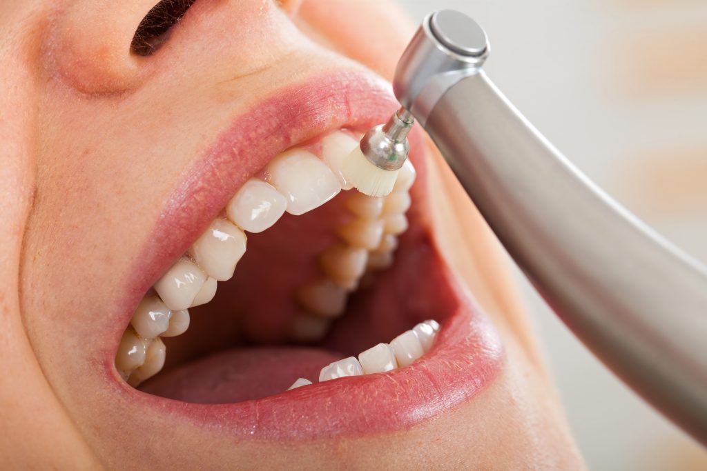 ¿Por qué debes realizarte una limpieza dental profesional cada año?