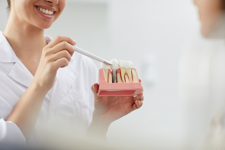 ¿Cuándo puedo ponerme implantes de carga inmediata?