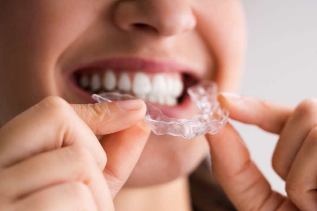 ¿Cuáles son las ventajas de la ortodoncia invisible para adultos?