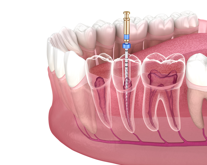 ¿Cómo sé si necesito una endodoncia?
