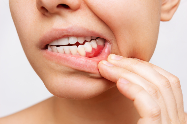 ¿Cómo podemos prevenir las enfermedades periodontales?