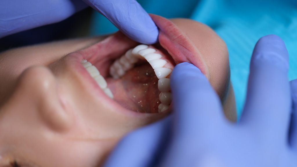 ¿Cuáles son los beneficios de un tratamiento con carillas dentales?