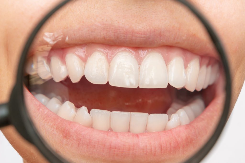 ¿Qué es la fluorosis dental?
