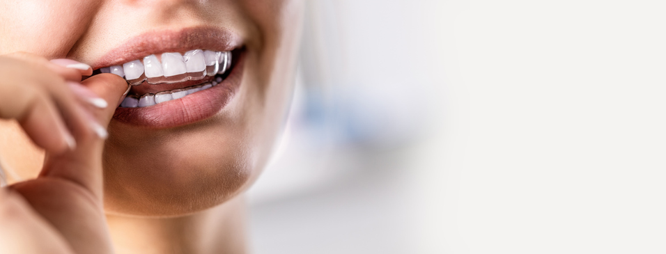 ¿Cómo puedo mejorar mi estética si tengo los dientes apiñados?