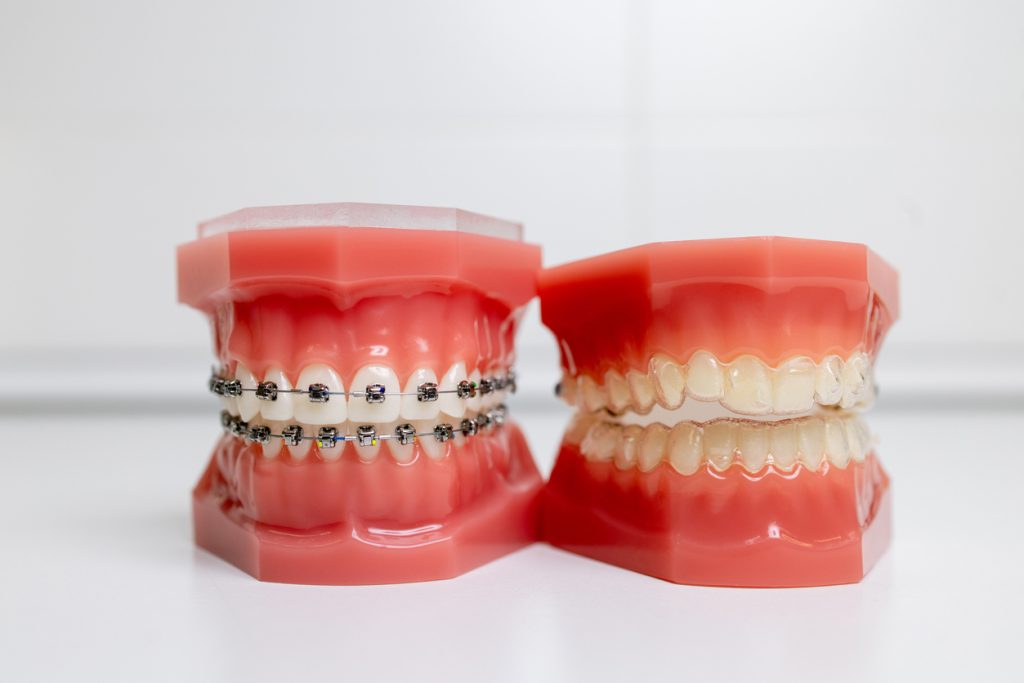 ¿Ortodoncia invisible o brackets?